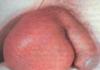 Опухло яичко у мужчины: причины и методы лечения заболеваний