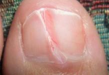 Как вылечить деформацию ногтевой пластины на ноге