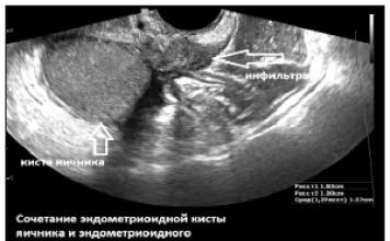 Способ диагностики ретроцервикального эндометриоза и эндометриоза крестцово-маточных связок Эндометриоз крестцово маточных связок симптомы