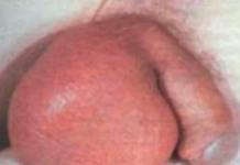 Опухло яичко у мужчины: причины и методы лечения заболеваний